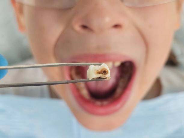 Best Emergency Broken Tooth Repair in Traer, IA